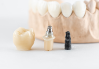 DVine-Dental-Arts_Screw Retained Implant